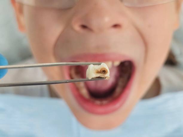 Best Emergency Care for Gum Disease in Bellevue, WI